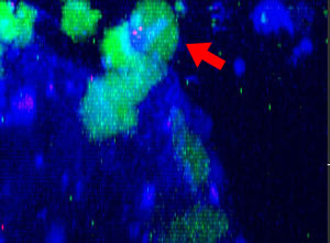 Fig. 2: NK cell line KHYG-1 (green) changing shape while attacking and killing HT-29 tumor cells labeled with cetuximab (blue). PI uptake (red) indicates cell death. 17h