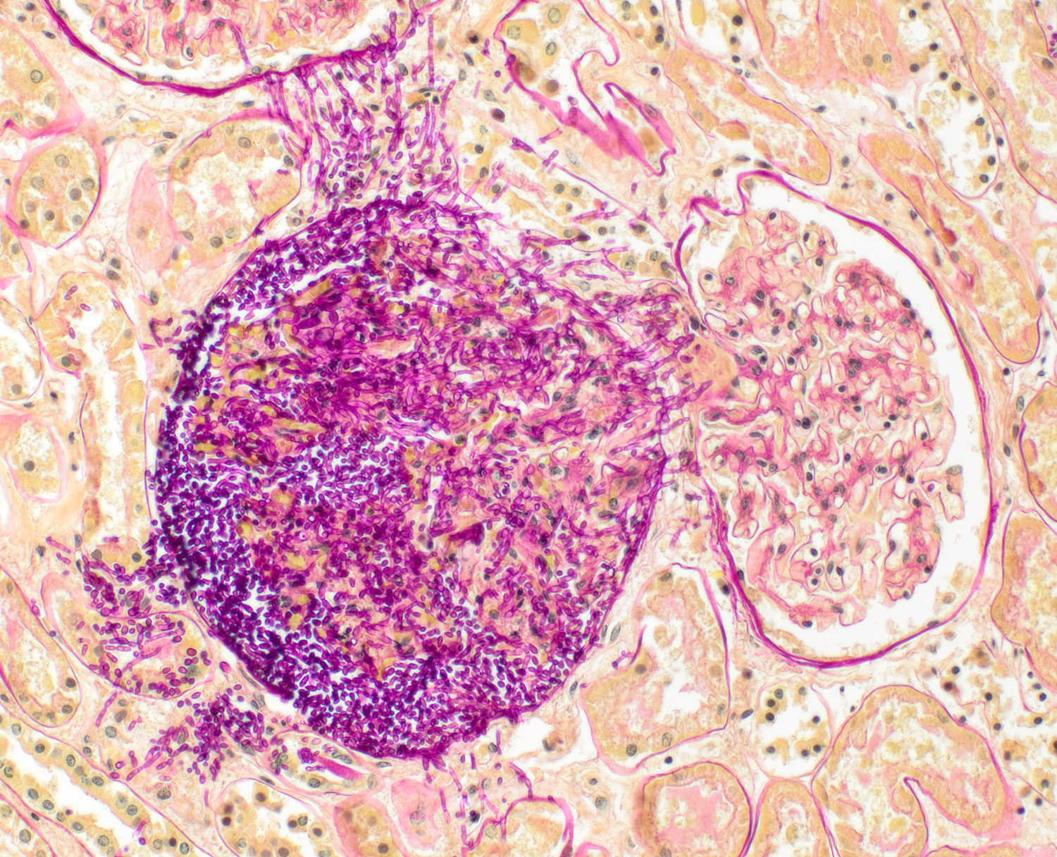 Niere mit Candida | 10X Vergrößerung