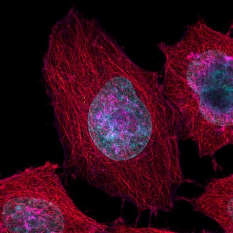 显微镜下的人宫颈癌传代细胞