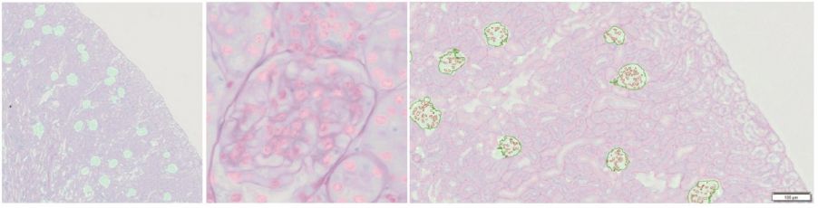 Drei Probenbilder mit TruAI Technologie und gezählten Glomeruli und Zellkernen der Niere