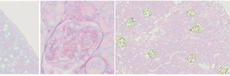 Three slide sample images showing TruAI labeled and counted glomeruli and renal nuclei